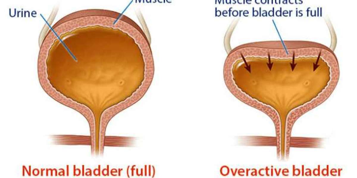 Size and Share of Overactive Bladder Market by 2033