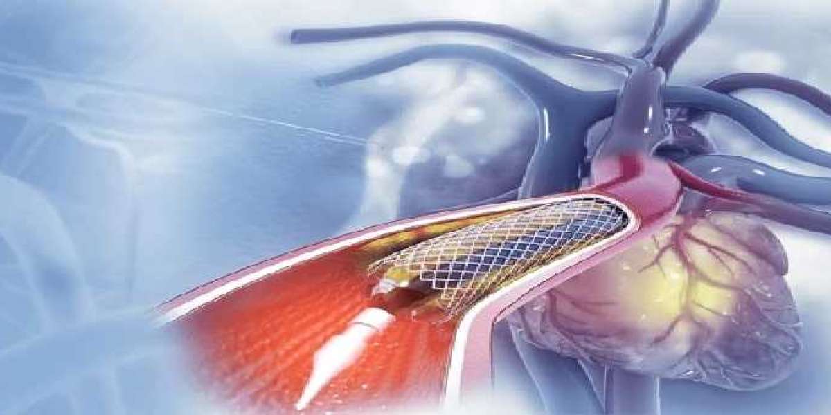 Why Our Hospital is the Leading Choice for Angioplasty Surgery in Chhattisgarh