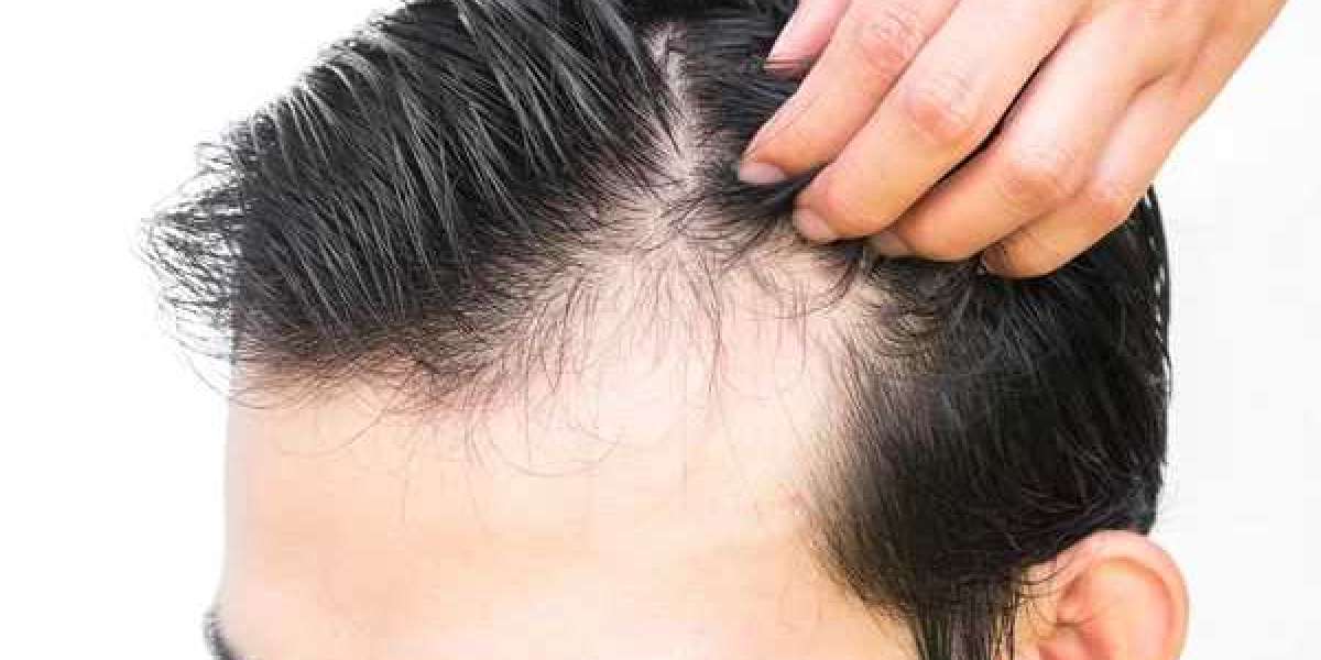 The donor area plays a crucial role in hair transplantation